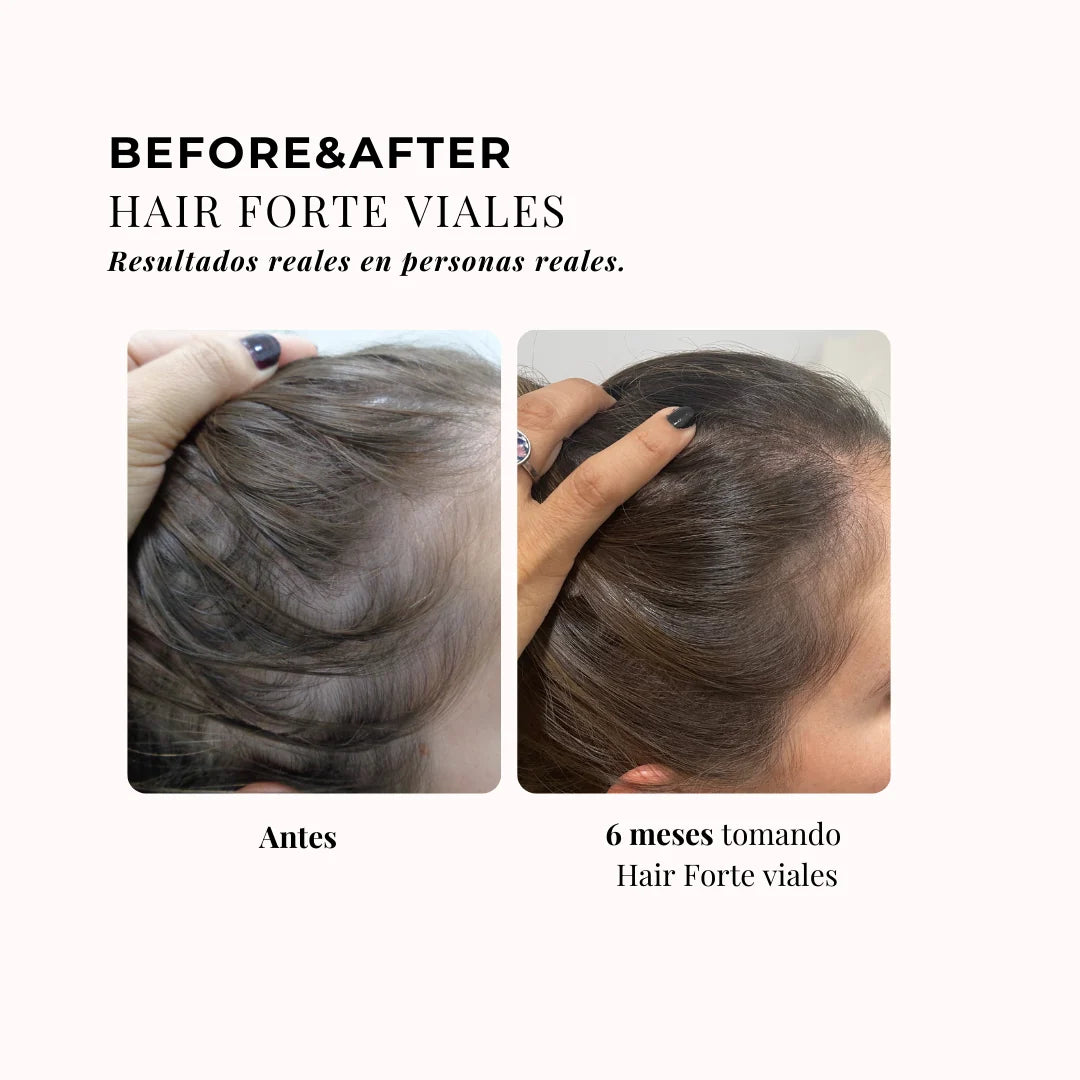 Chic & Love Viales Hair Forte anticaída 5-alfa reductasa